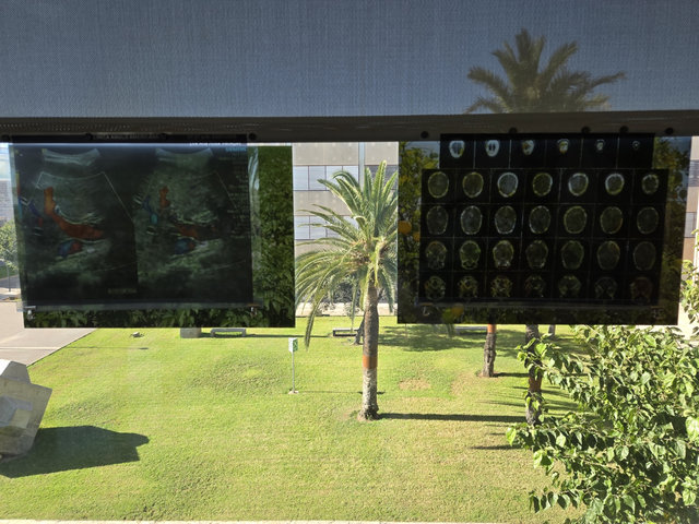 Una ecografia i una sèrie d'escàners cerebrals en làmines transparents, penjades davant d'una finestra que dona a una gespa amb palmeres